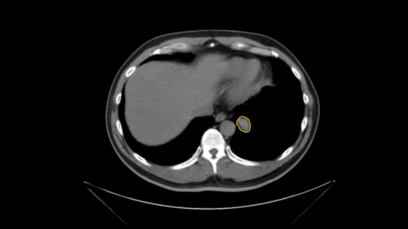 Cloud-Based Medical Imaging Platform with AI-Assisted Segmentation